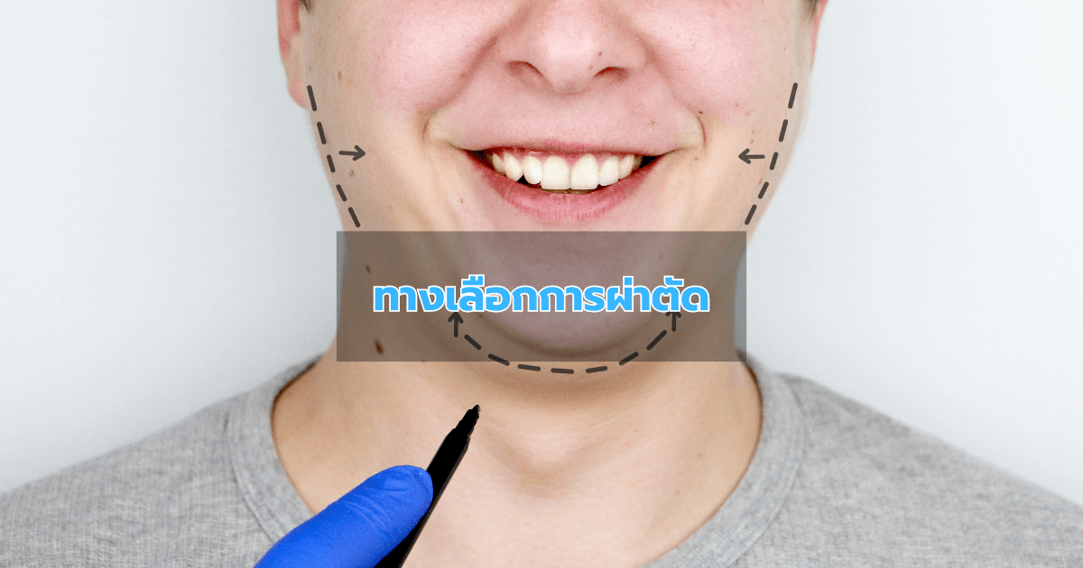 ทางเลือกการผ่าตัด